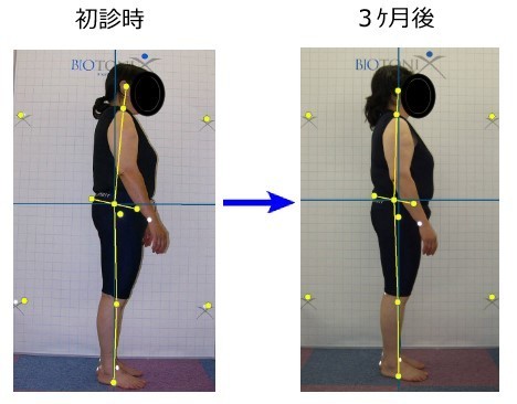 Improving forward leaning posture
