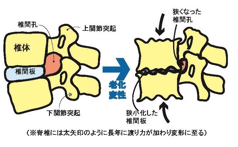 脊椎間狭窄の図