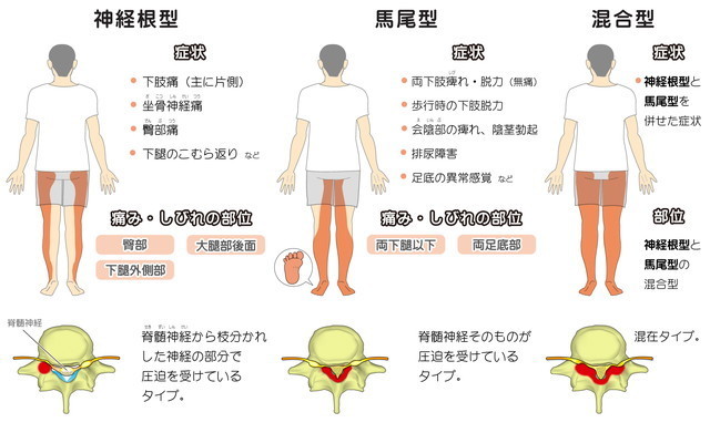 脊柱管狭窄症の神経障害形式