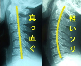 ストレートネックについて ｋｃｓセンター たかの施術院