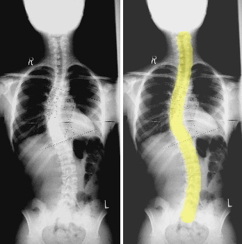 子供の腰痛 ｋｃｓセンター たかの施術院