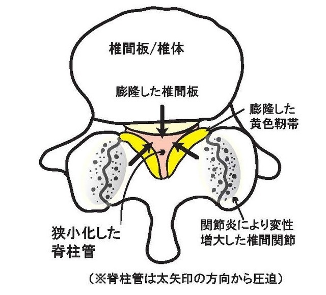 上から見た脊柱管狭窄症の簡略図