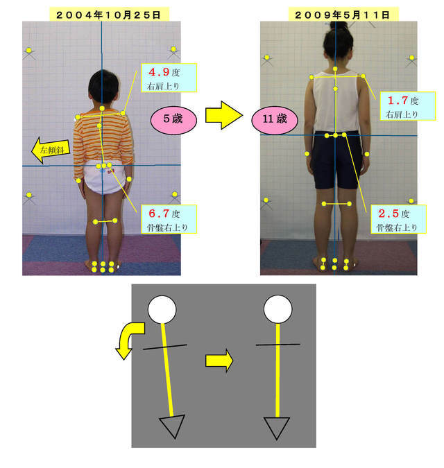 子供の姿勢の改善例