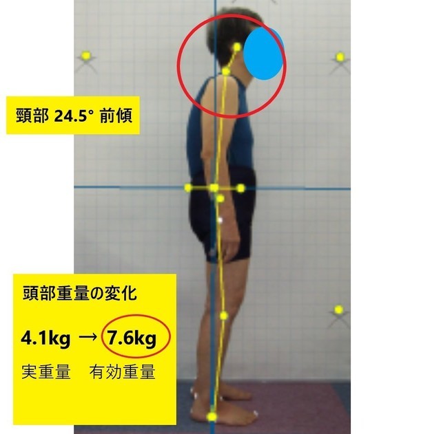 頸部前傾角度により力学的負担増