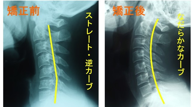 ストレートネック　レントゲン