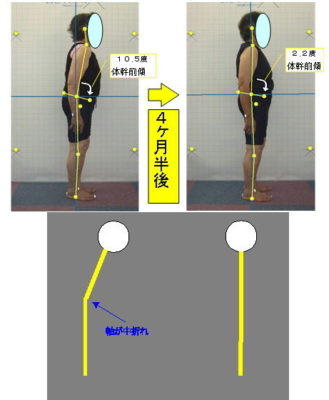 腰猫背の改善例