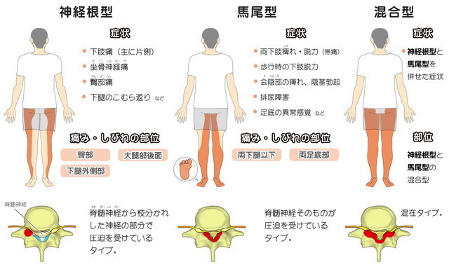 脊柱管狭窄症って難しい名称