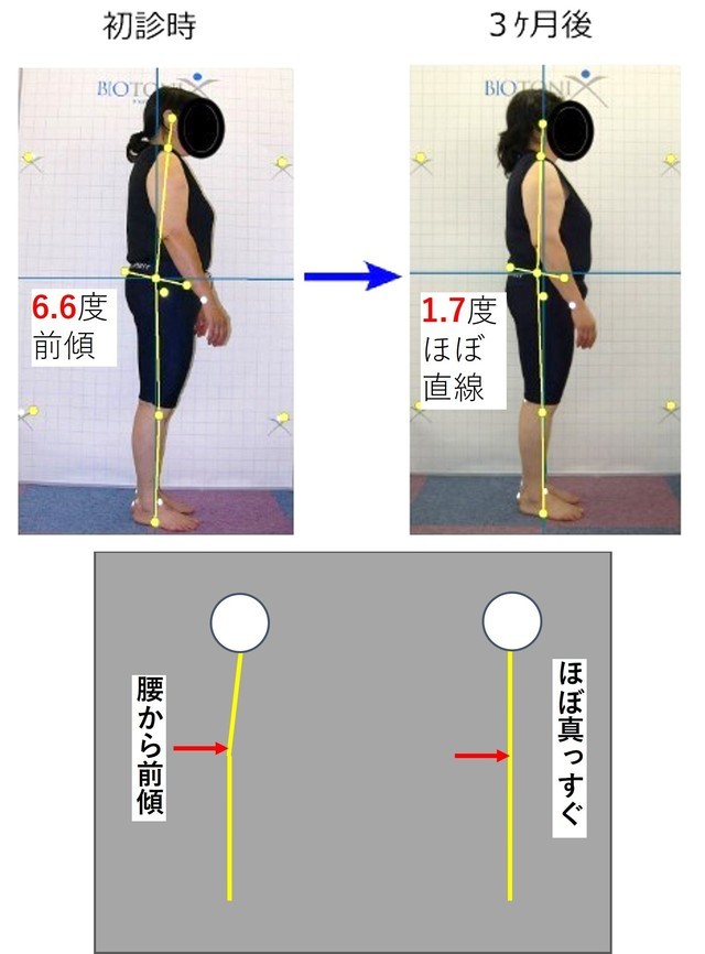 Improving forward leaning posture