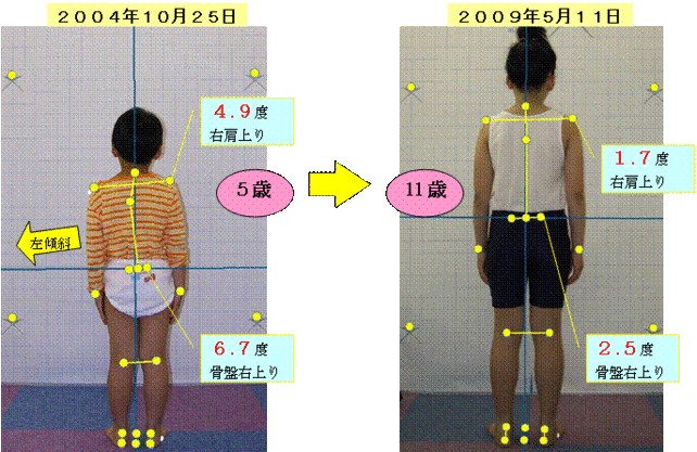 子供の姿勢の追跡