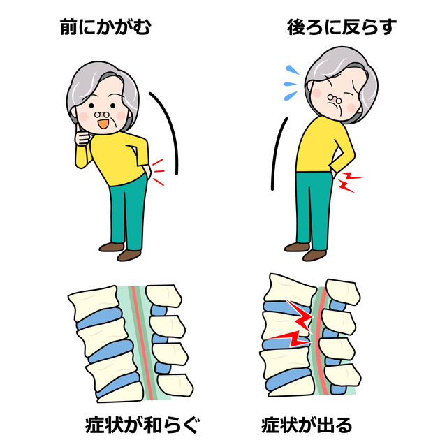 脊柱管狭窄症って難しい名称