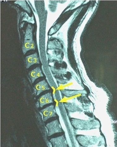 ストレートネック　頸椎ＭＲＩ　ヘルニア