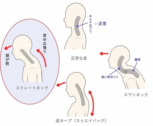 ストレートネックや首の骨の並びの変化
