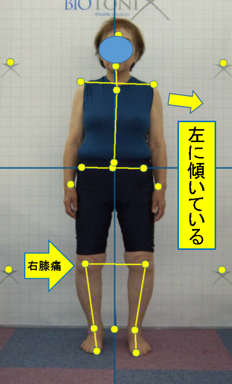 膝痛の方で体が横に傾いている