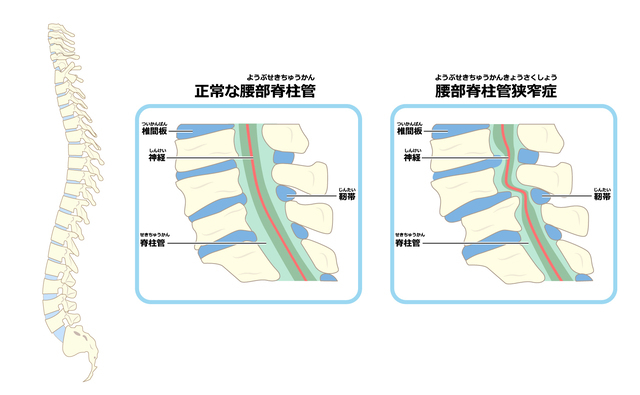 脊柱管狭窄症って難しい名称