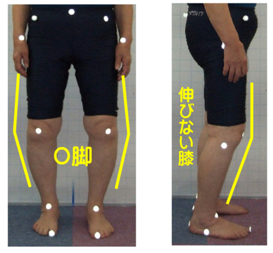 変形性膝関節症を根本解消させる - KCSセンター たかの施術院